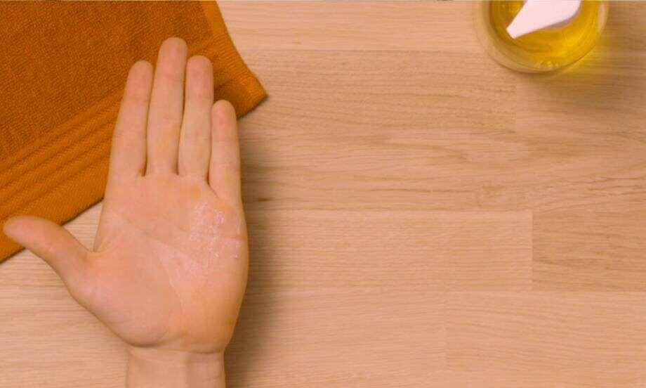 Ireland how to remove super glue from skin teaser